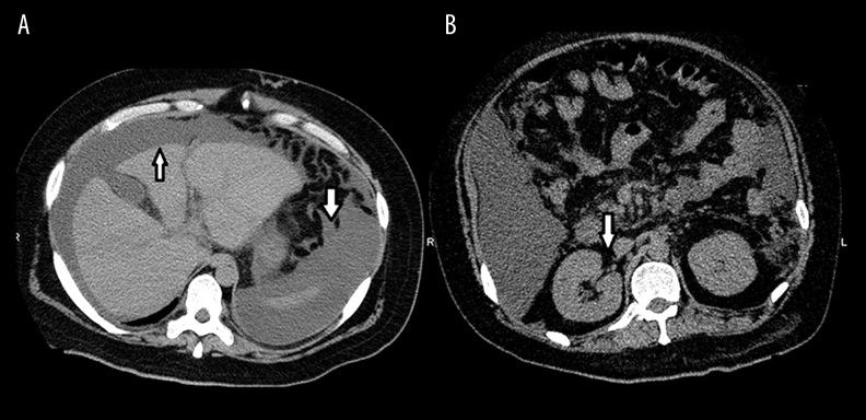 https://cdn.ncbi.nlm.nih.gov/pmc/blobs/24e0/5616135/d41f044bab04/amjcaserep-18-1000-g001.jpg