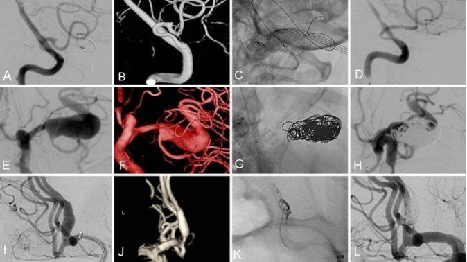 https://cdn.ncbi.nlm.nih.gov/pmc/blobs/24e6/6582735/b5de6e9e2592/neurintsurg-2018-014363f01.jpg