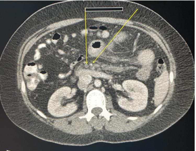 https://cdn.ncbi.nlm.nih.gov/pmc/blobs/254b/10347885/742ddf659c41/cureus-0015-00000040407-i01.jpg