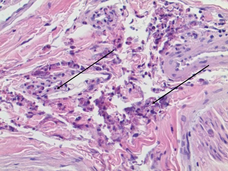 https://cdn.ncbi.nlm.nih.gov/pmc/blobs/2570/8831231/11e422295831/cureus-0014-00000021176-i01.jpg