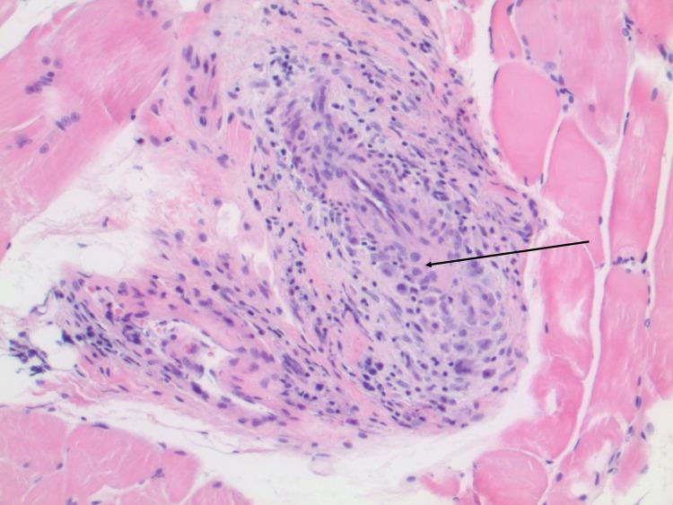 https://cdn.ncbi.nlm.nih.gov/pmc/blobs/2570/8831231/4d5918ffb6e0/cureus-0014-00000021176-i02.jpg
