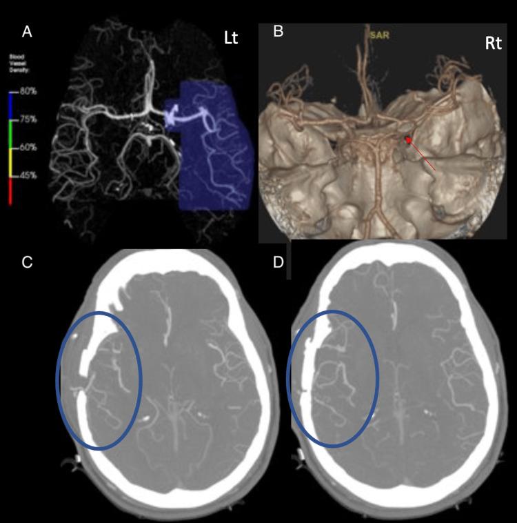 https://cdn.ncbi.nlm.nih.gov/pmc/blobs/258a/11019475/7bf92acd9f85/cureus-0016-00000056317-i04.jpg