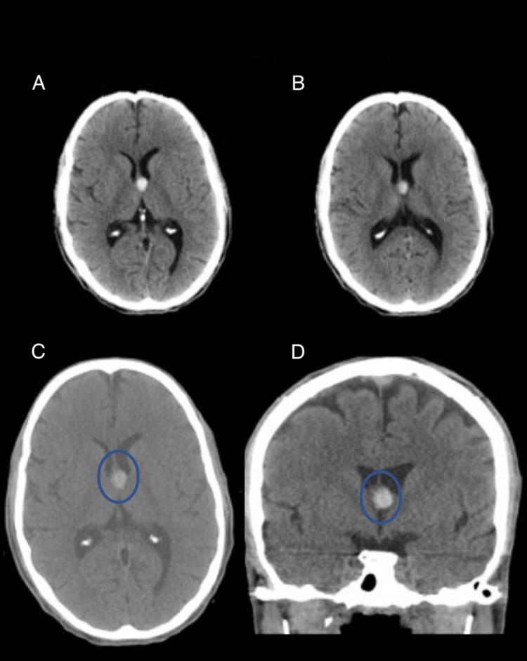 https://cdn.ncbi.nlm.nih.gov/pmc/blobs/258a/11019475/a096eba52fb8/cureus-0016-00000056317-i03.jpg