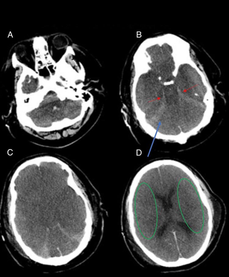 https://cdn.ncbi.nlm.nih.gov/pmc/blobs/258a/11019475/c9397eb28ebe/cureus-0016-00000056317-i01.jpg