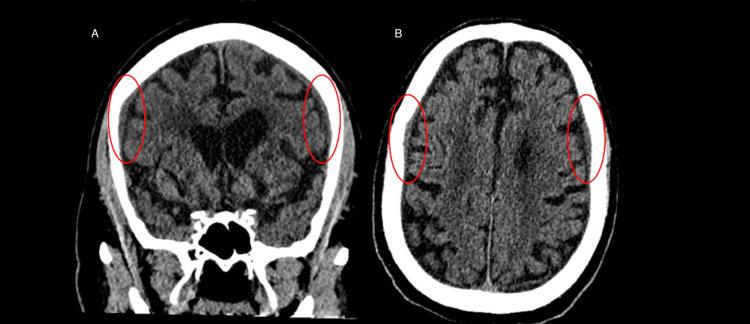 https://cdn.ncbi.nlm.nih.gov/pmc/blobs/258a/11019475/dac4d67de854/cureus-0016-00000056317-i05.jpg