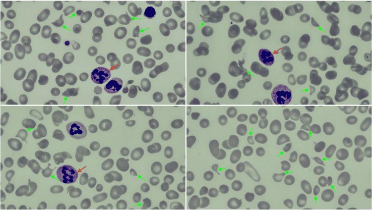 https://cdn.ncbi.nlm.nih.gov/pmc/blobs/2655/11285735/3bae9f49682c/cureus-0016-00000063478-i01.jpg