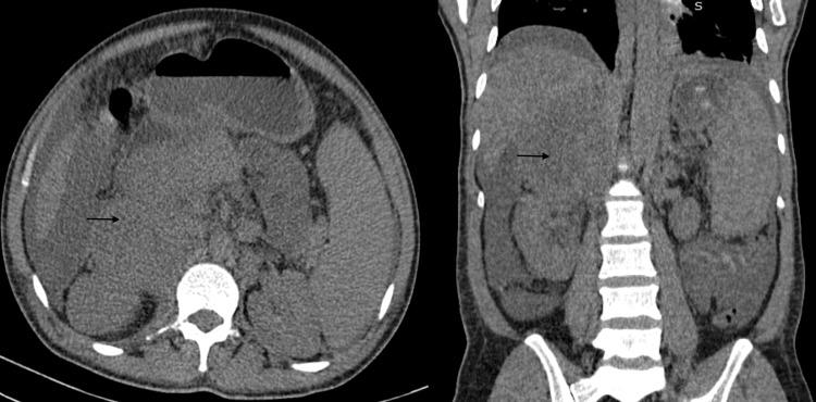 https://cdn.ncbi.nlm.nih.gov/pmc/blobs/267c/11745834/51587d02a914/cureus-0016-00000076155-i01.jpg