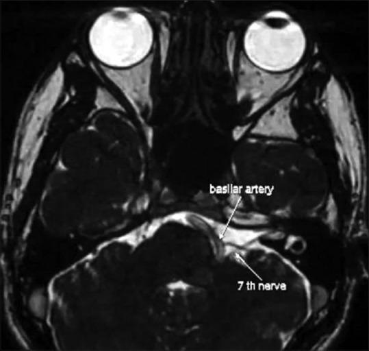 https://cdn.ncbi.nlm.nih.gov/pmc/blobs/2683/7933878/930edf1135f9/IJO-69-253-g003.jpg
