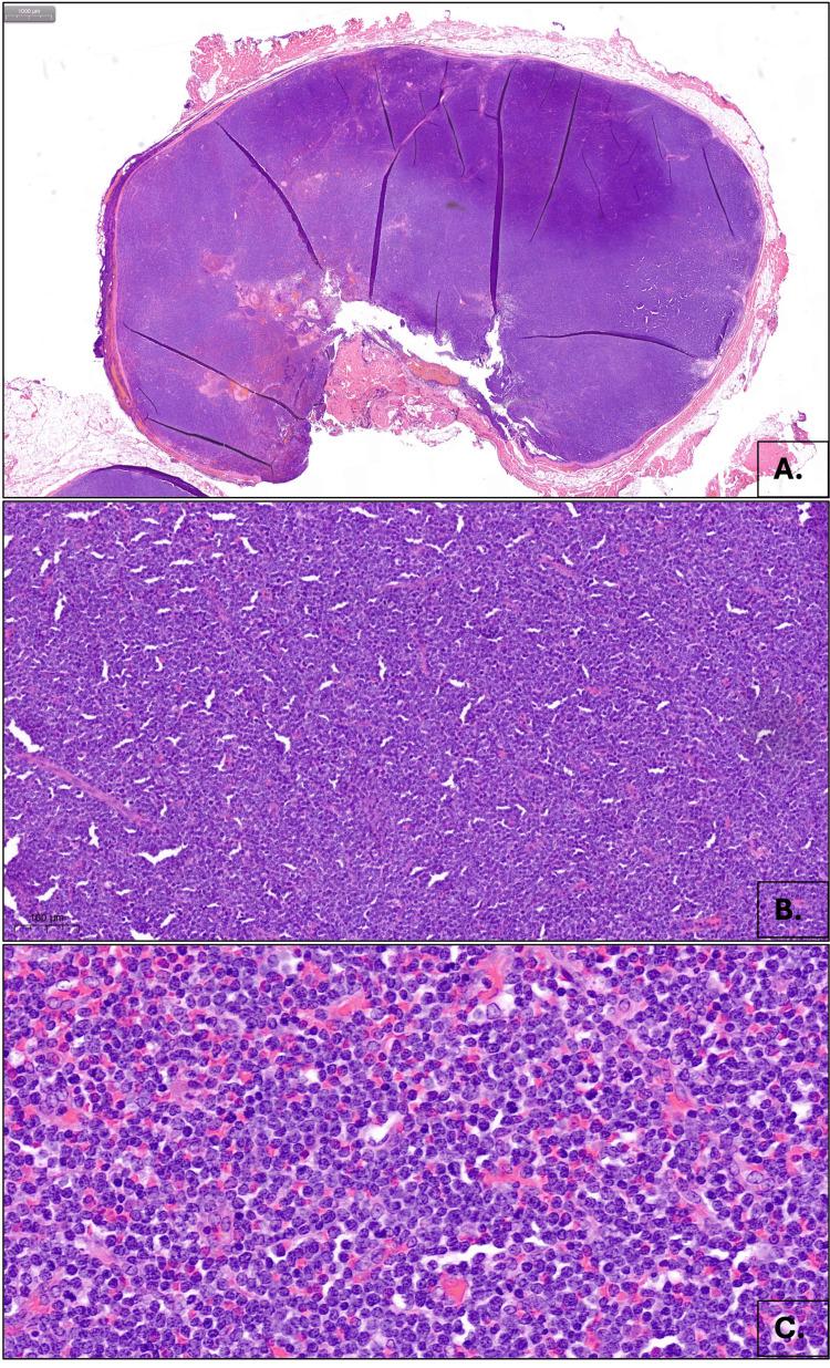 https://cdn.ncbi.nlm.nih.gov/pmc/blobs/2692/12221112/72e0d2132222/cureus-0017-00000085214-i01.jpg