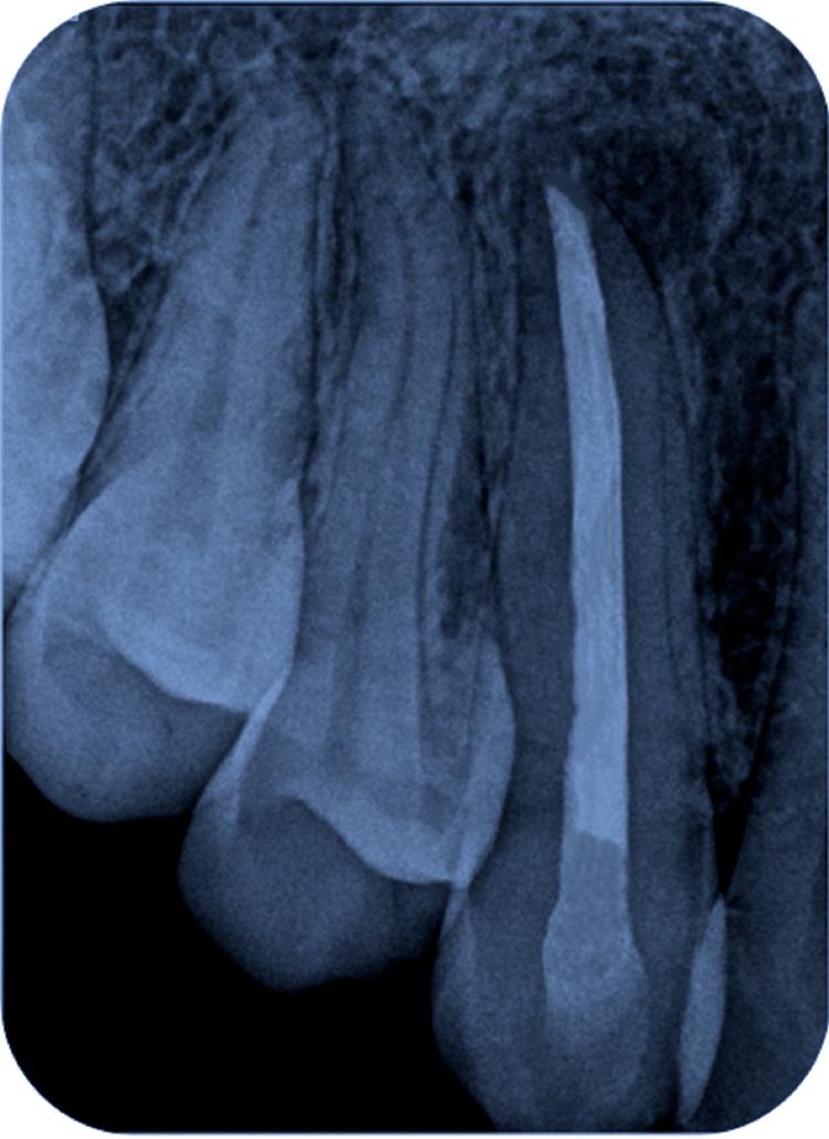 https://cdn.ncbi.nlm.nih.gov/pmc/blobs/26dc/11246771/a29b1811d55c/cureus-0016-00000062349-i09.jpg
