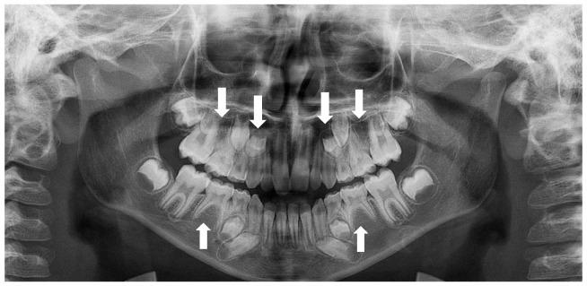 https://cdn.ncbi.nlm.nih.gov/pmc/blobs/2770/10047183/0d4870ffe29f/children-10-00596-g012.jpg