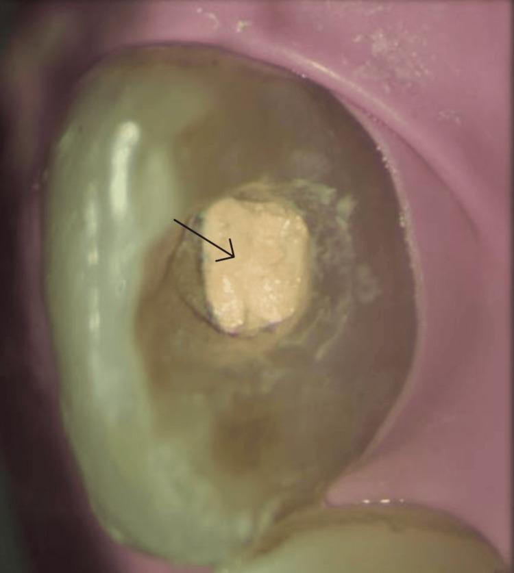 https://cdn.ncbi.nlm.nih.gov/pmc/blobs/2787/11470832/799cf21d41b5/cureus-0016-00000069280-i09.jpg