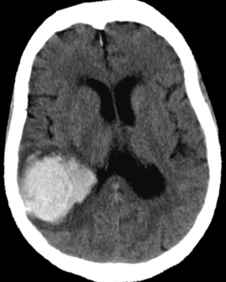 https://cdn.ncbi.nlm.nih.gov/pmc/blobs/27b2/7982923/2242941ea10a/practneurol-2020-002763f02.jpg