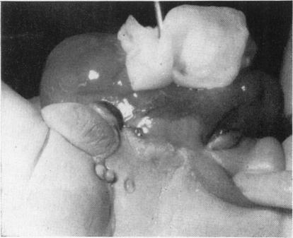 https://cdn.ncbi.nlm.nih.gov/pmc/blobs/27b4/2012499/a7c072471a9f/archdisch01604-0105-a.jpg
