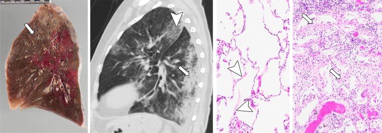 https://cdn.ncbi.nlm.nih.gov/pmc/blobs/280e/7977757/d852d9f5487e/ryct.2020200406.fig6a.jpg