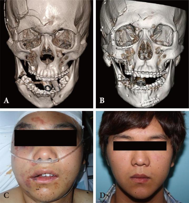 https://cdn.ncbi.nlm.nih.gov/pmc/blobs/281e/5556780/61e96dacd6e7/acfs-16-119-g002.jpg