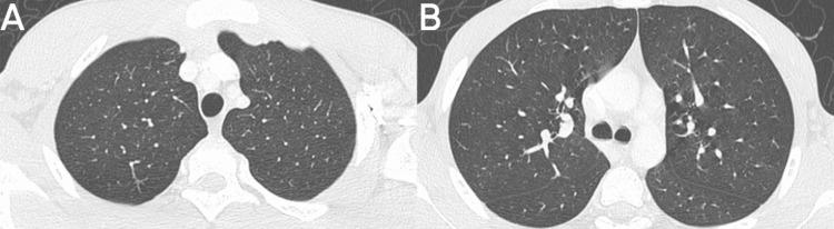 https://cdn.ncbi.nlm.nih.gov/pmc/blobs/2826/10978459/31ede446d69e/cureus-0016-00000055095-i04.jpg