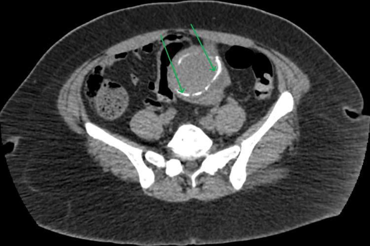 https://cdn.ncbi.nlm.nih.gov/pmc/blobs/2853/12083509/07a1eb4db24e/cureus-0017-00000082373-i05.jpg