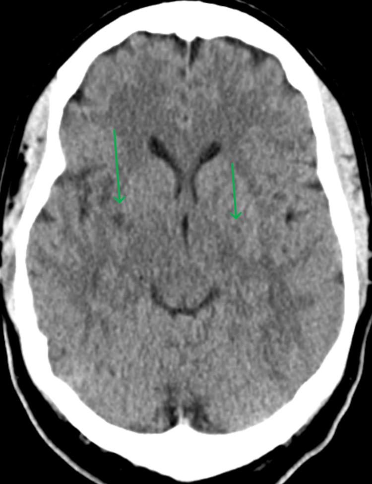 https://cdn.ncbi.nlm.nih.gov/pmc/blobs/2853/12083509/41315fc2c18d/cureus-0017-00000082373-i01.jpg