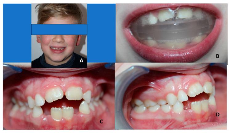 https://cdn.ncbi.nlm.nih.gov/pmc/blobs/2860/10670240/4b6dd5de2c64/children-10-01821-g005.jpg
