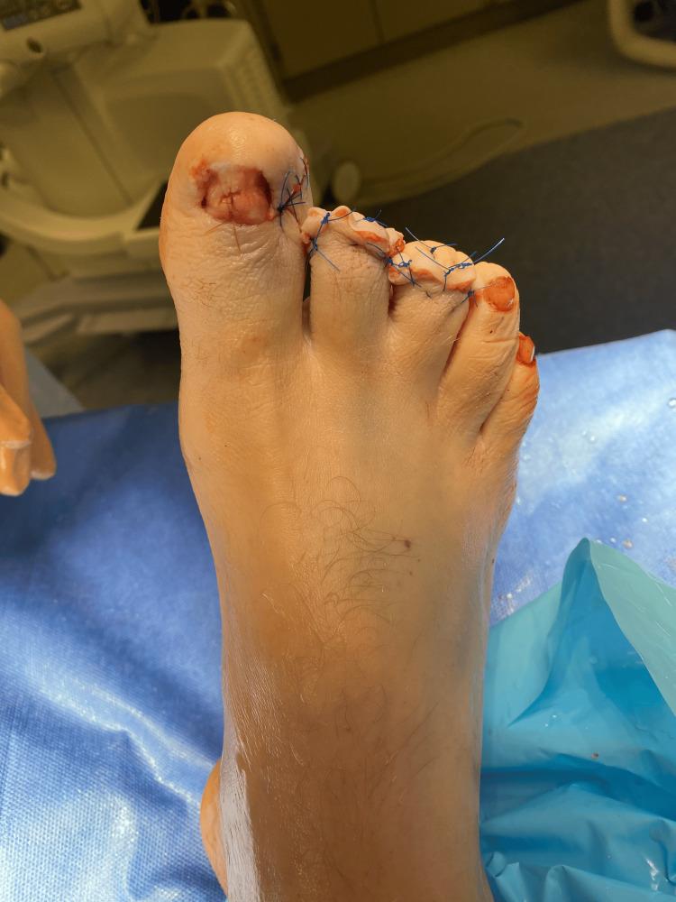 https://cdn.ncbi.nlm.nih.gov/pmc/blobs/2884/12374256/0106bda519cf/cureus-0017-00000088655-i05.jpg