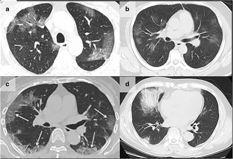 https://cdn.ncbi.nlm.nih.gov/pmc/blobs/28aa/7156903/f43848d03604/330_2020_6827_Fig3_HTML.jpg