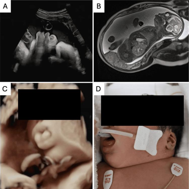 https://cdn.ncbi.nlm.nih.gov/pmc/blobs/28ae/12075991/b2ca930ec968/cureus-0017-00000082215-i01.jpg