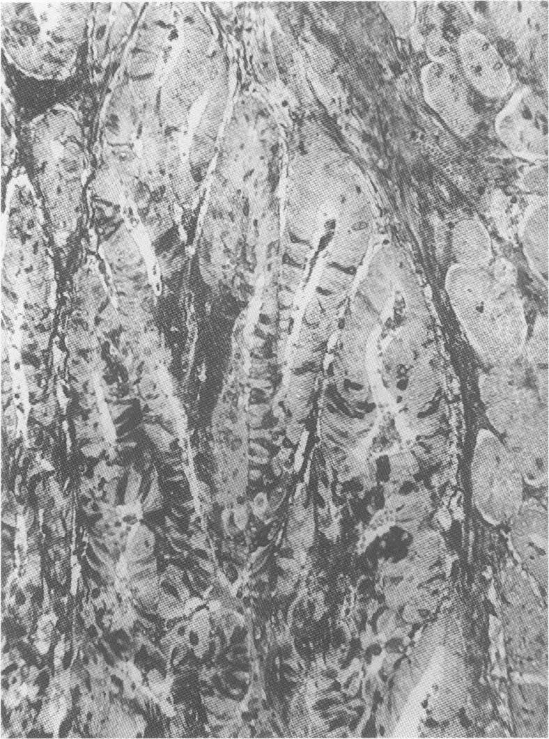 https://cdn.ncbi.nlm.nih.gov/pmc/blobs/28de/2150151/9bc468198680/brjcancer00084-0069-a.jpg