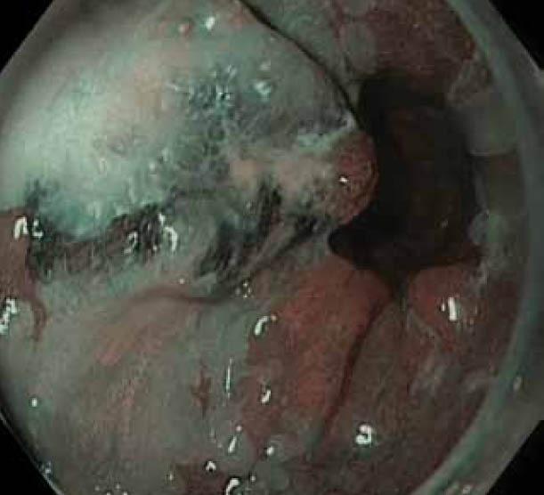 https://cdn.ncbi.nlm.nih.gov/pmc/blobs/28ea/3959381/165312b21c63/AnnGastroenterol-25-89-g003.jpg