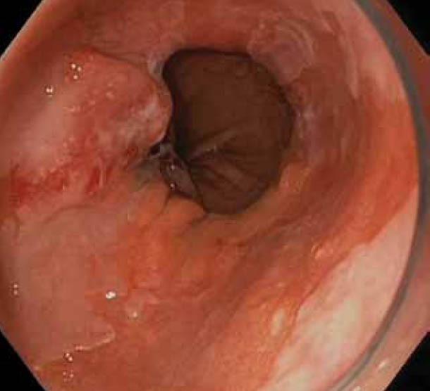 https://cdn.ncbi.nlm.nih.gov/pmc/blobs/28ea/3959381/27e4936cd83c/AnnGastroenterol-25-89-g002.jpg