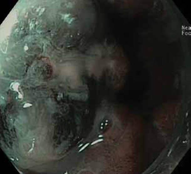 https://cdn.ncbi.nlm.nih.gov/pmc/blobs/28ea/3959381/dcc850e4bc79/AnnGastroenterol-25-89-g004.jpg