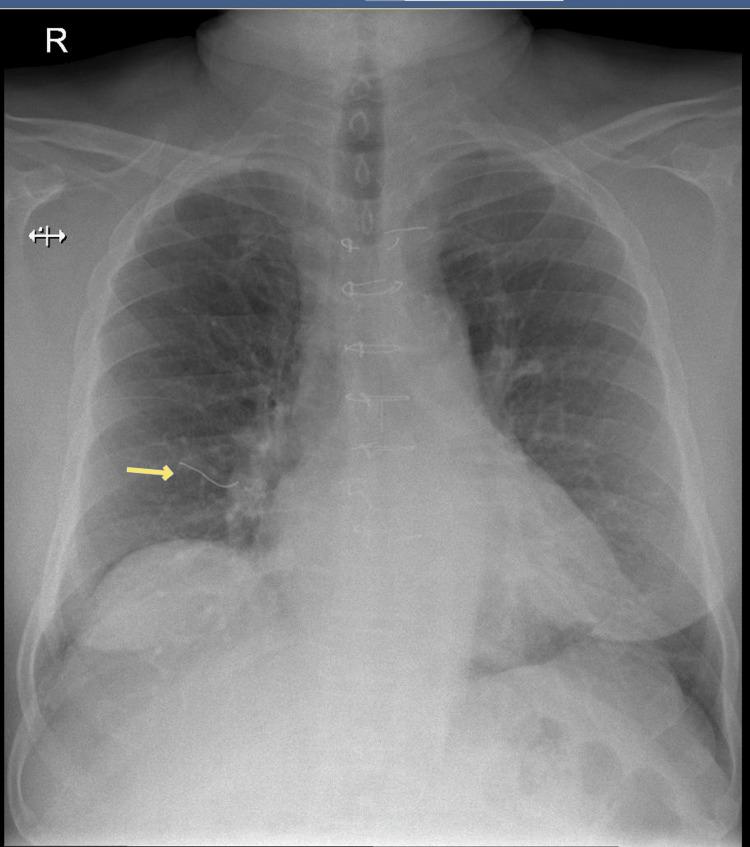 https://cdn.ncbi.nlm.nih.gov/pmc/blobs/2903/12460196/114bf3abc895/cureus-0017-00000090915-i05.jpg