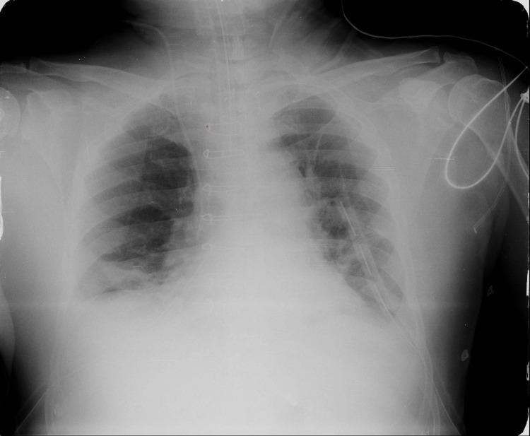 https://cdn.ncbi.nlm.nih.gov/pmc/blobs/2903/12460196/8d21ba7d1de8/cureus-0017-00000090915-i02.jpg