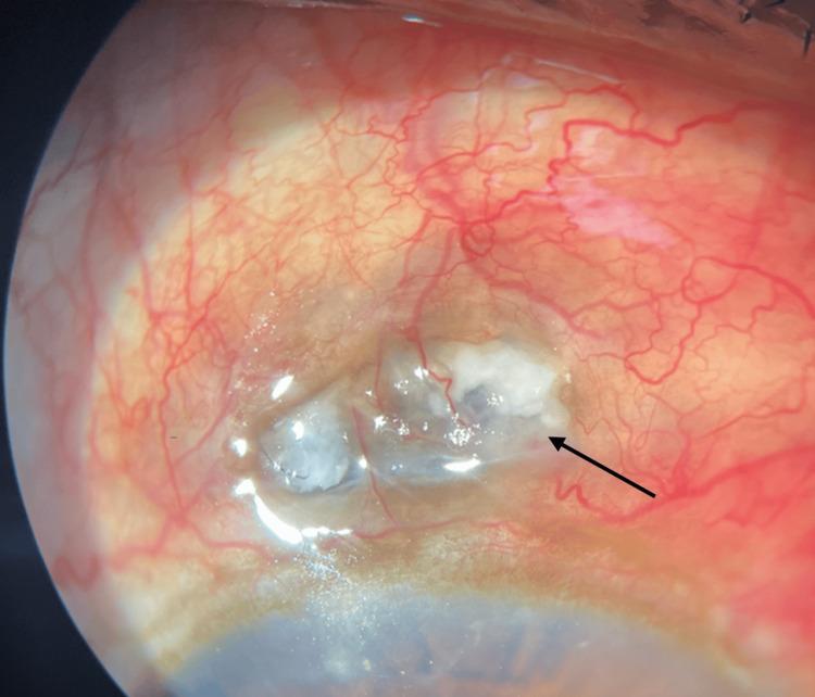 https://cdn.ncbi.nlm.nih.gov/pmc/blobs/291b/11531864/e85bb9c3cc45/cureus-0016-00000070861-i01.jpg