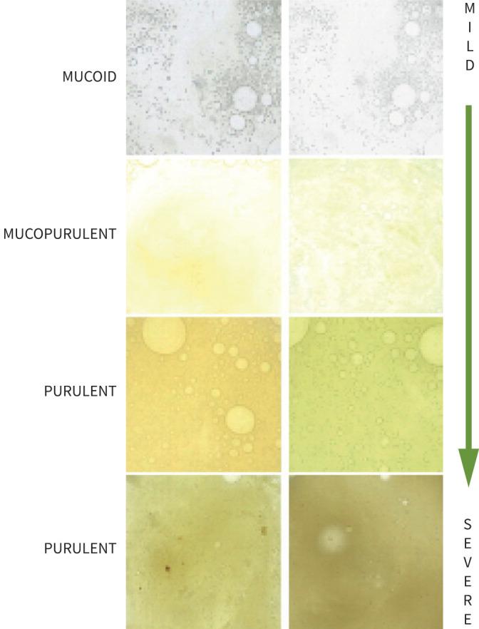 https://cdn.ncbi.nlm.nih.gov/pmc/blobs/292e/11024393/bf2cbce7a0bb/ERJ-01554-2023.01.jpg