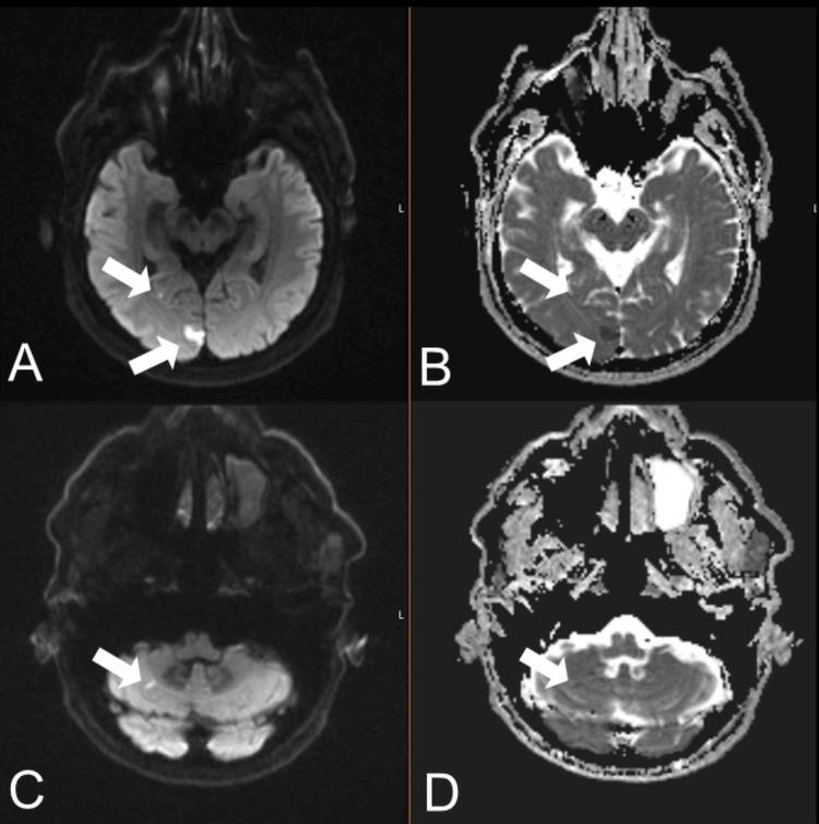 https://cdn.ncbi.nlm.nih.gov/pmc/blobs/2938/12427593/38adcb86f569/cureus-0017-00000089981-i02.jpg