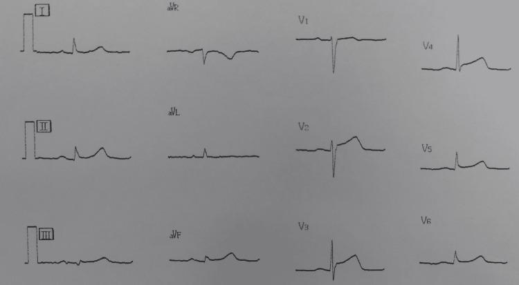 https://cdn.ncbi.nlm.nih.gov/pmc/blobs/2965/9236697/158e9442842d/cureus-0014-00000025389-i02.jpg