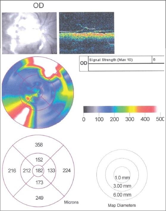 https://cdn.ncbi.nlm.nih.gov/pmc/blobs/29b8/2636155/1def7549b8b7/IndianJOphthalmol-56-329-g005.jpg