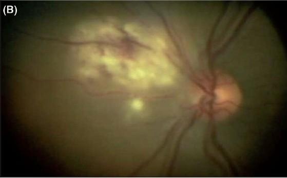 https://cdn.ncbi.nlm.nih.gov/pmc/blobs/29b8/2636155/be7c19e34fca/IndianJOphthalmol-56-329-g007.jpg