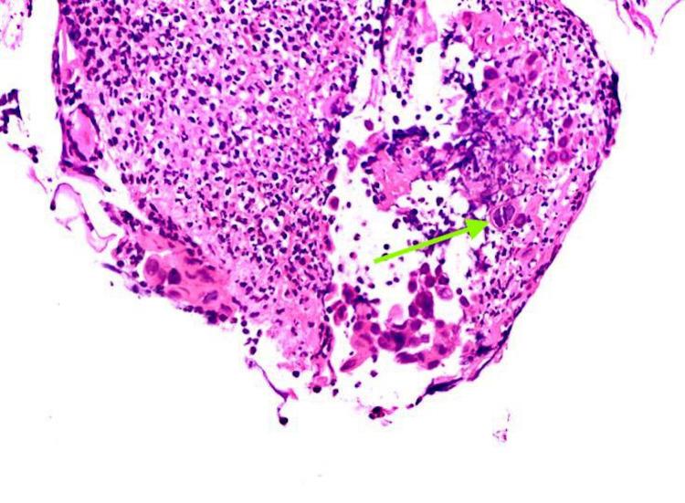 https://cdn.ncbi.nlm.nih.gov/pmc/blobs/2a2c/8278358/30b878d53443/cureus-0013-00000015635-i02.jpg