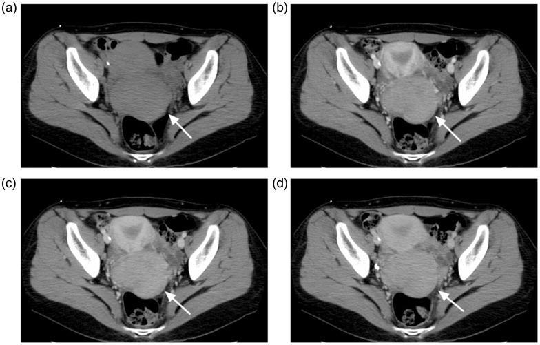 https://cdn.ncbi.nlm.nih.gov/pmc/blobs/2a7d/5405894/31e013045895/10.1177_2058460117701515-fig2.jpg