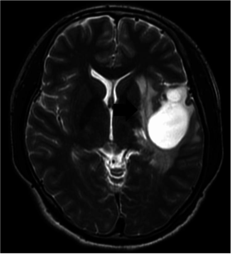https://cdn.ncbi.nlm.nih.gov/pmc/blobs/2aa1/10817826/d0e13dc19e6c/cureus-0015-00000051193-i07.jpg