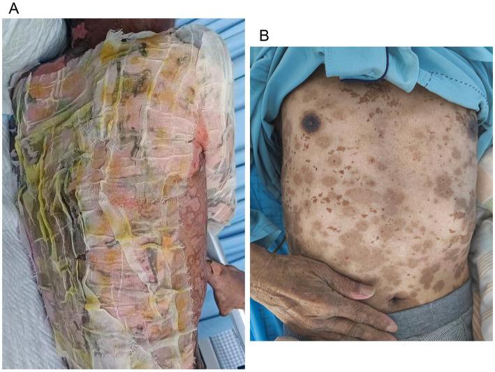 https://cdn.ncbi.nlm.nih.gov/pmc/blobs/2aab/11700972/052e207e3d4f/fmed-11-1522525-g003.jpg