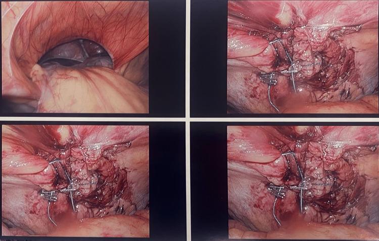 https://cdn.ncbi.nlm.nih.gov/pmc/blobs/2ab8/10511027/bcbf3136a069/cureus-0015-00000043859-i01.jpg