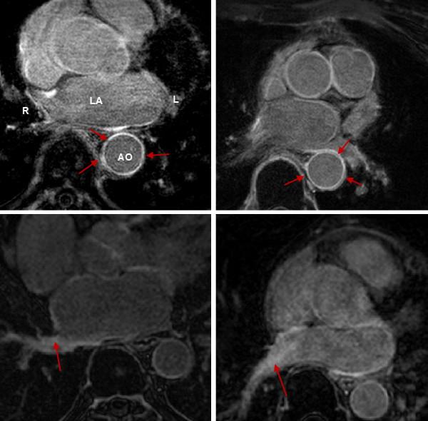 https://cdn.ncbi.nlm.nih.gov/pmc/blobs/2b98/3878126/d7f1d3f96fa8/1532-429X-15-105-7.jpg
