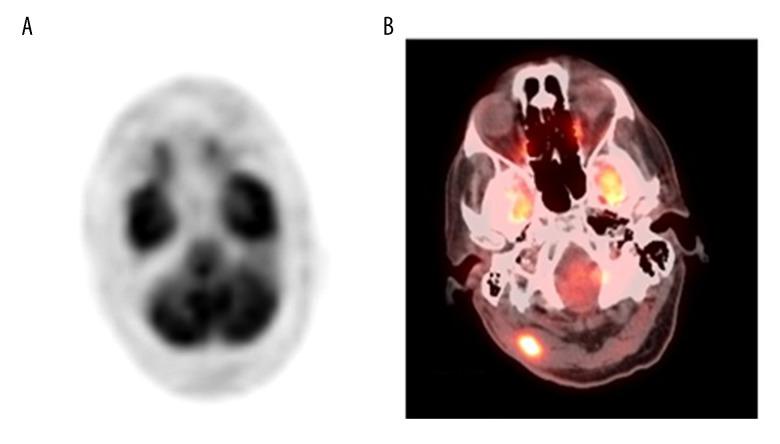 https://cdn.ncbi.nlm.nih.gov/pmc/blobs/2b99/6380207/7b6c1c9242fb/amjcaserep-20-179-g003.jpg