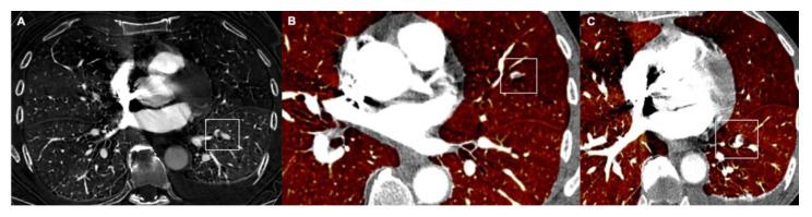 https://cdn.ncbi.nlm.nih.gov/pmc/blobs/2be6/8880178/76ee4f48b51d/tomography-08-00042-g005.jpg