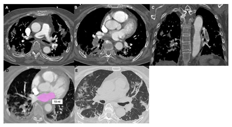 https://cdn.ncbi.nlm.nih.gov/pmc/blobs/2be6/8880178/8264d97b66ef/tomography-08-00042-g004.jpg