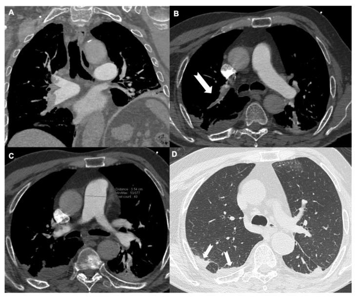 https://cdn.ncbi.nlm.nih.gov/pmc/blobs/2be6/8880178/f890fa6b642e/tomography-08-00042-g002.jpg