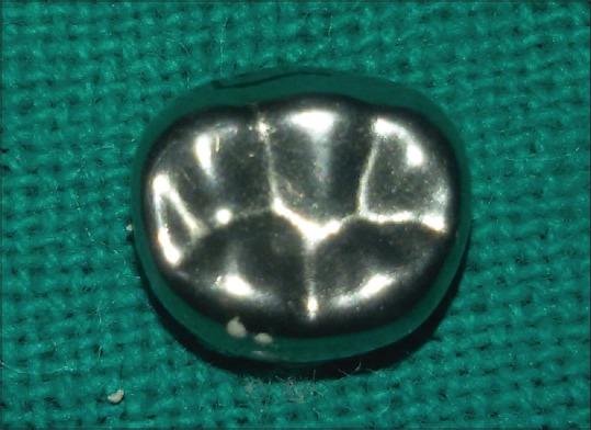 https://cdn.ncbi.nlm.nih.gov/pmc/blobs/2bed/4934093/b398acf01a11/IJDENT-7-81-g001.jpg